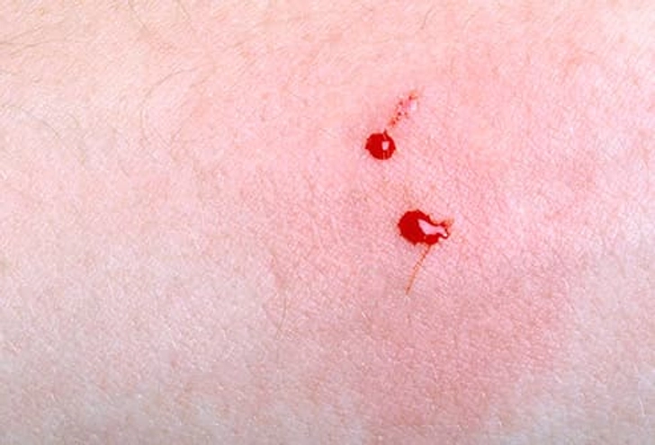 Pit Viper Bite Symptoms Pit Viper Bite Symptoms