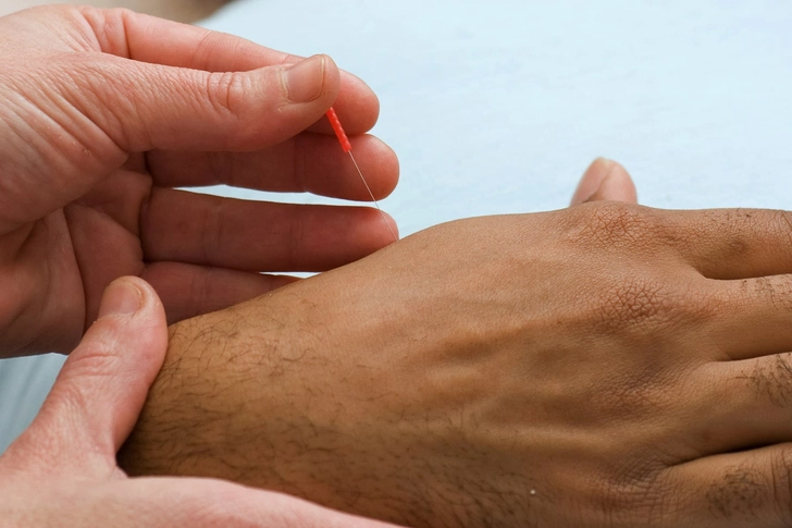 Try Acupuncture or Acupressure
