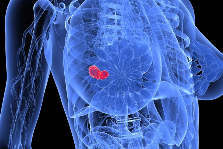 Breast Cancer