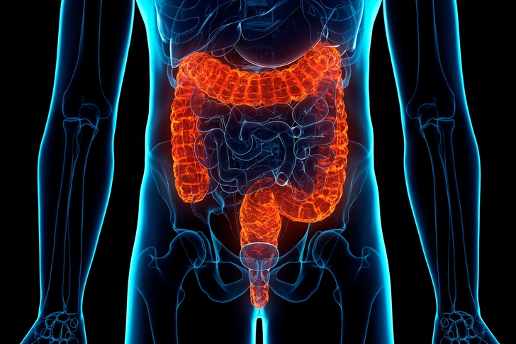 Ulcerative Colitis