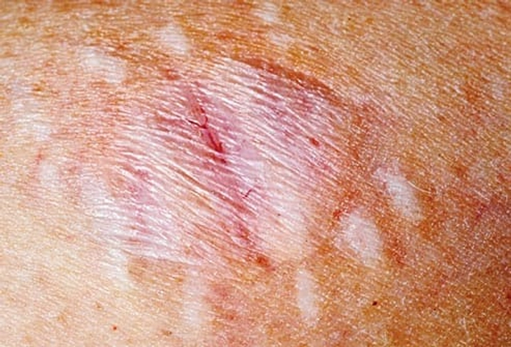 What’s a Brown Recluse Bite Like?