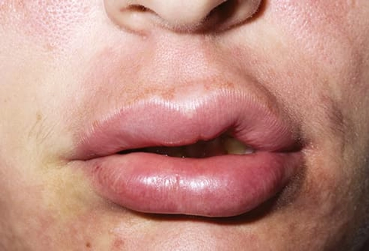 Allergic Reactions