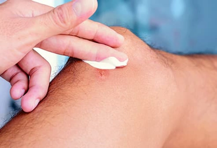 Treatment for Brown Recluse Bites Treatment for Brown Recluse Bites