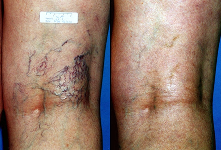 Sclerotherapy: Before and After