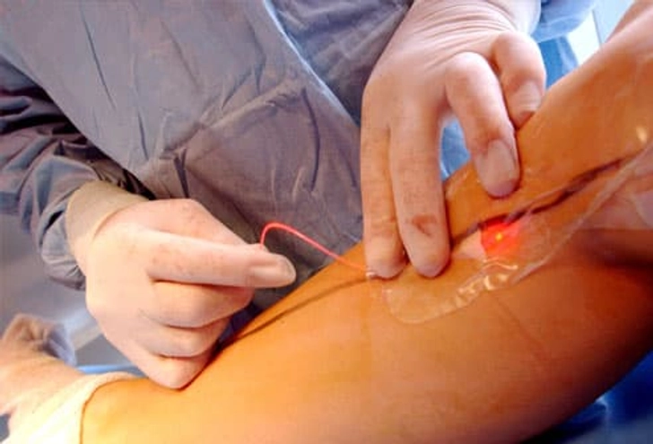 Treatment: Endovenous Laser