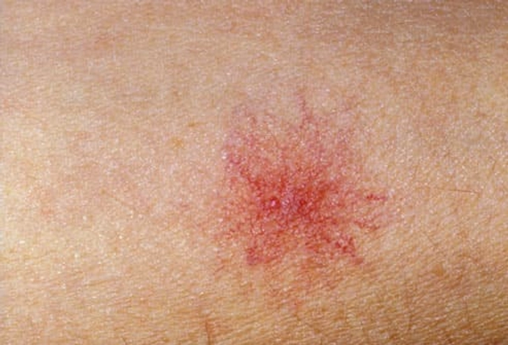 What Are Spider Veins? What Are Spider Veins?