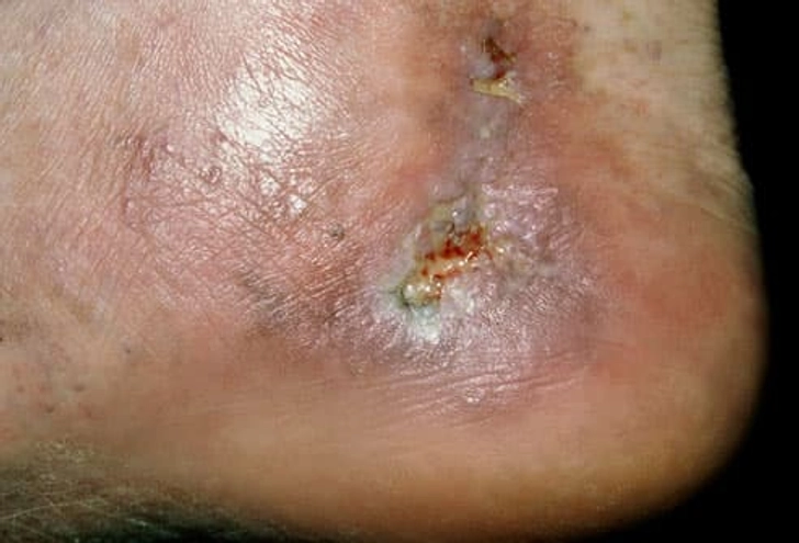 Spider/Varicose Vein Complications