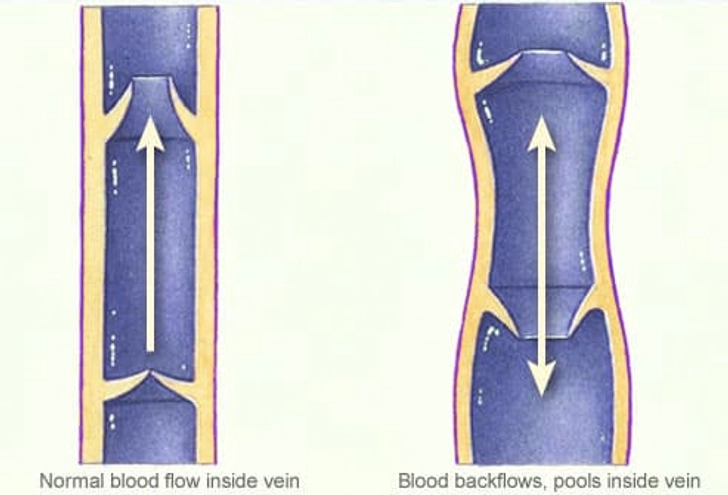 What Causes Spider/Varicose Veins?