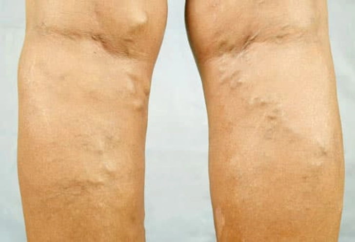 What Are Varicose Veins?