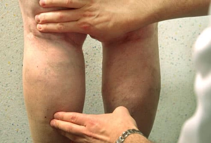 Diagnosing Spider/Varicose Veins