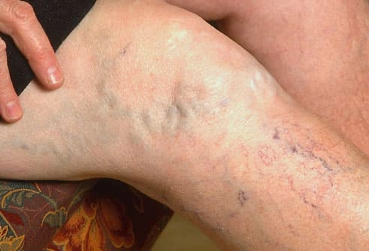 Spider/Varicose Vein Symptoms