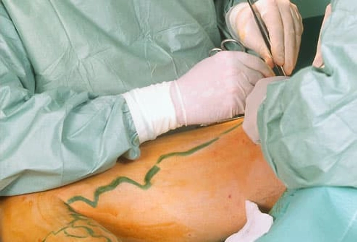 Treatment: Vein Surgery
