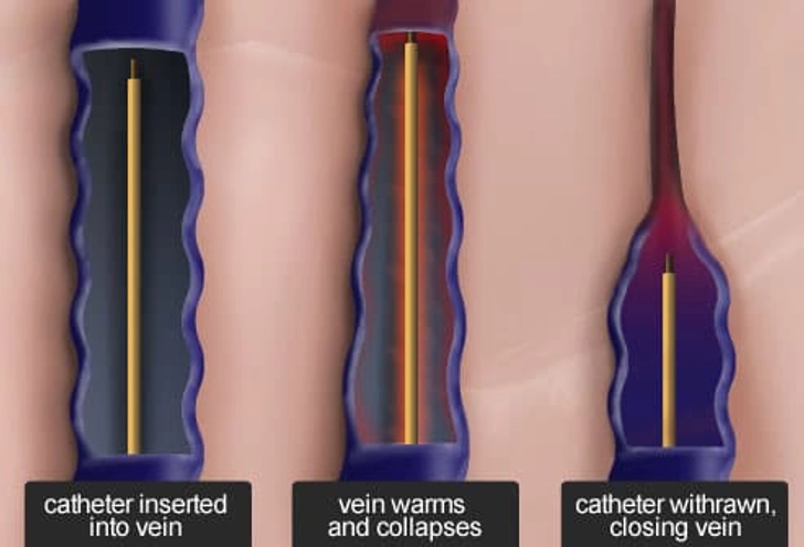 Treatment: Radiofrequency Ablation
