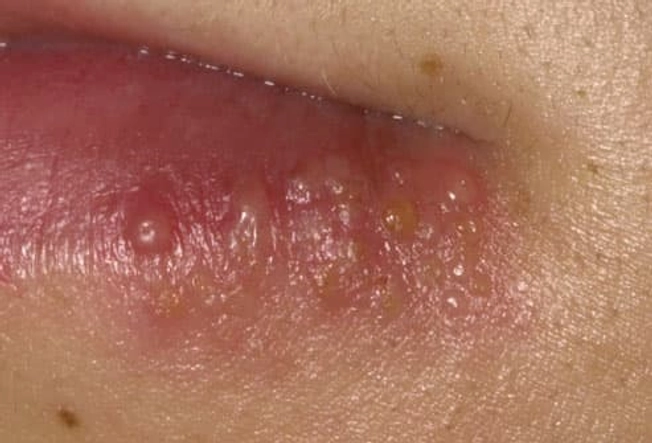 Herpes Simplex Virus Type 1 Herpes Simplex Virus Type 1