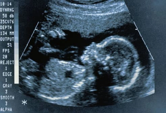 STDs and Pregnancy STDs and Pregnancy