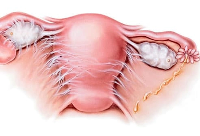 Pelvic Inflammatory Disease Pelvic Inflammatory Disease