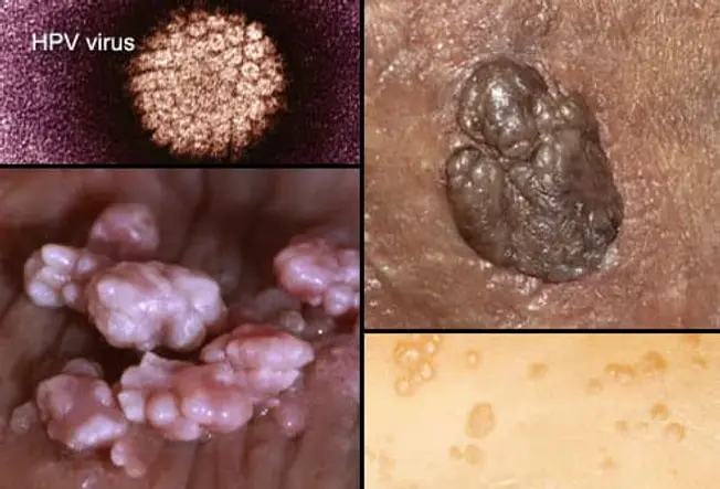 Genital Warts (HPV)