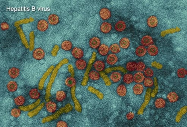 Hepatitis B Hepatitis B
