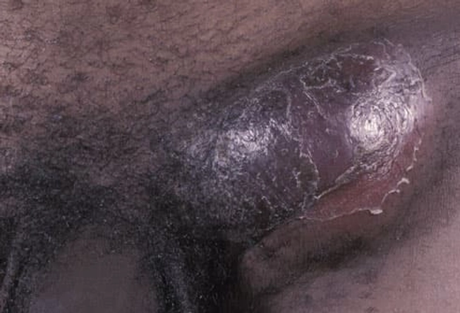 LGV (Lymphogranuloma Venereum) LGV (Lymphogranuloma Venereum)