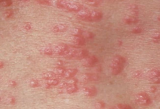Scabies Scabies