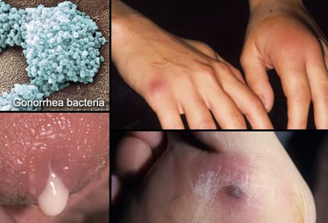 The Clap (Gonorrhea) The Clap (Gonorrhea)