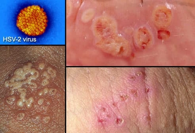 Herpes Simplex Virus Type 2 Herpes Simplex Virus Type 2