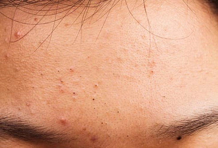 Corticosteroid Side Effects