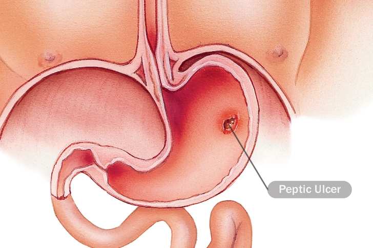 Peptic Ulcer Peptic Ulcer