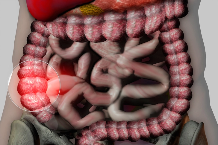 Irritable Bowel Syndrome Irritable Bowel Syndrome