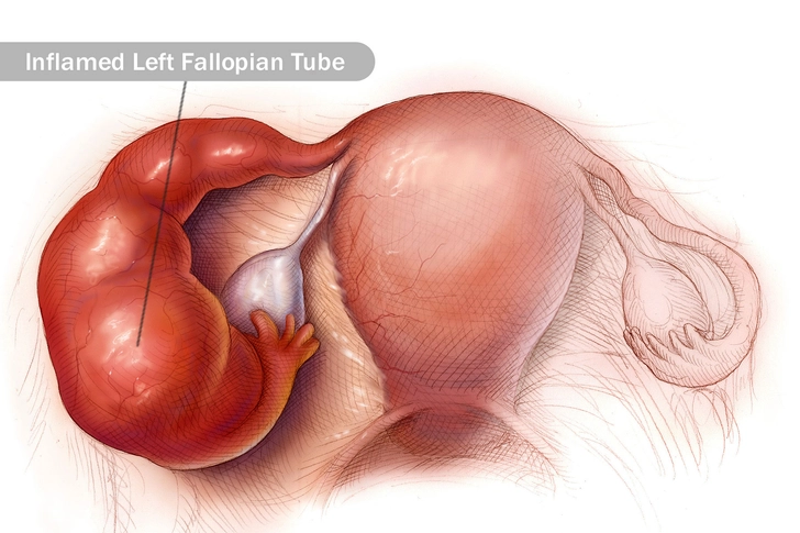 Pelvic Inflammatory Disease Pelvic Inflammatory Disease
