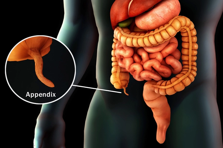 Appendicitis Appendicitis