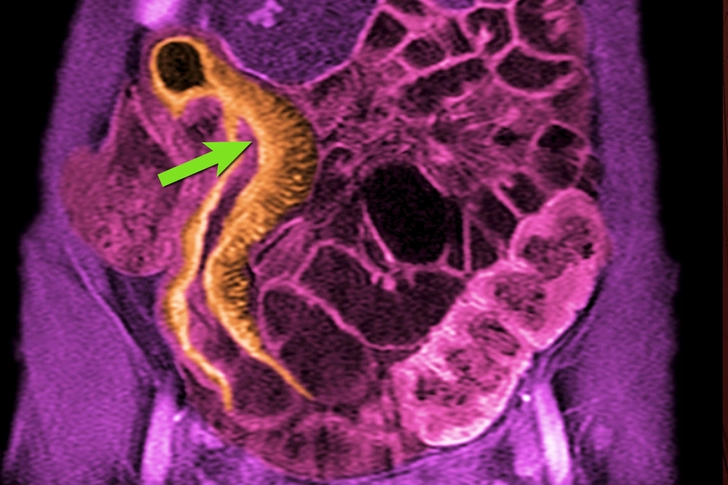 Inflammatory Bowel Disease (IBD) Inflammatory Bowel Disease (IBD)