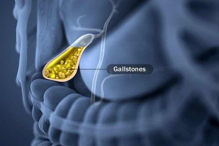 Gallbladder Attack Gallbladder Attack