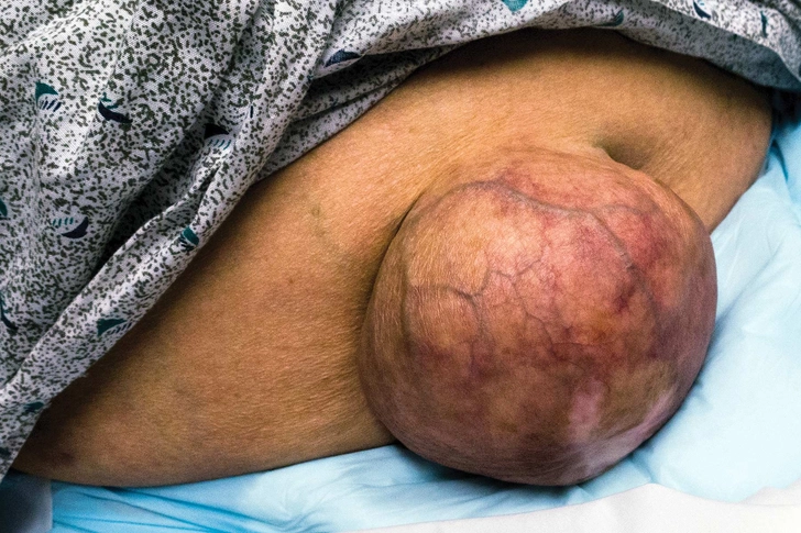 Incarcerated Hernia Incarcerated Hernia