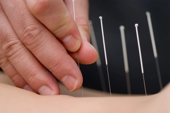 Try Acupuncture