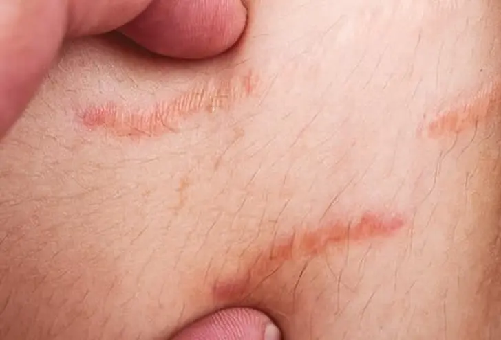 Stretch Marks Are Scars Stretch Marks Are Scars