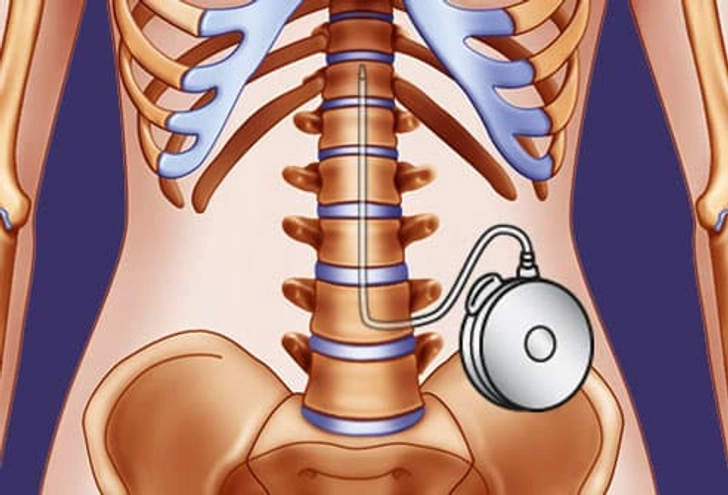 Intrathecal Baclofen Therapy for Spasticity Intrathecal Baclofen Therapy for Spasticity