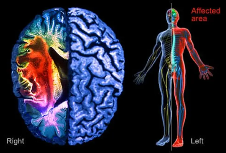 After a Stroke: Spasticity, Weakness, and Paralysis After a Stroke: Spasticity, Weakness, and Paralysis