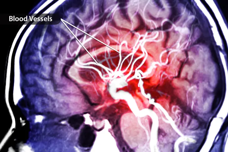 What Is a Stroke?