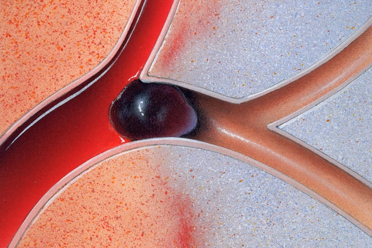 Ischemic Stroke