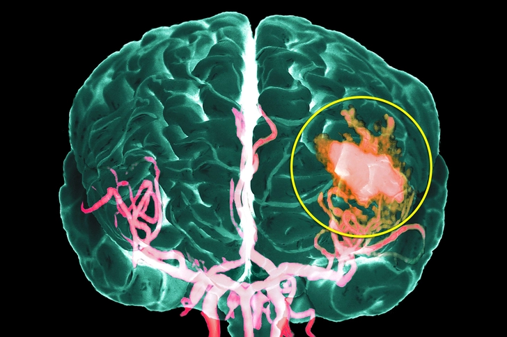 Hemorrhagic Stroke Hemorrhagic Stroke
