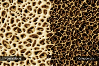 Find Out About Your Bone Health Find Out About Your Bone Health
