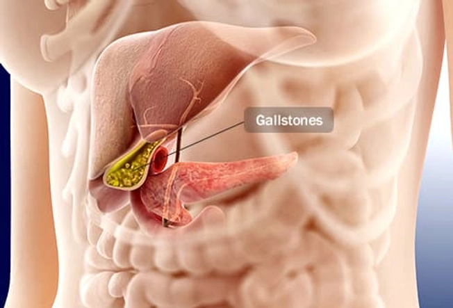 Gallstones Gallstones
