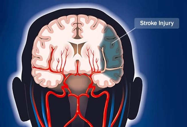 Stroke Stroke