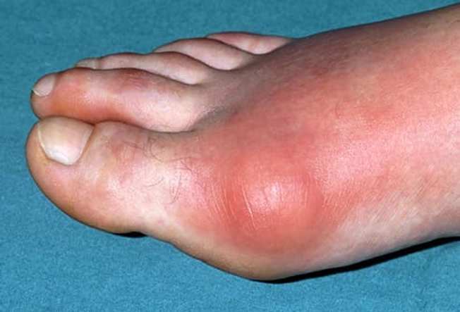 Gout Gout