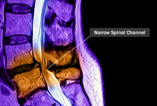 Spinal Stenosis Spinal Stenosis