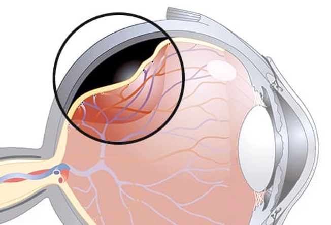 Detached Retina Detached Retina