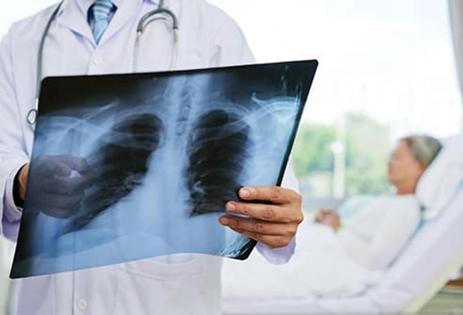 Pneumonia Pneumonia