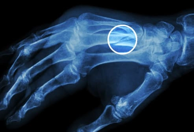 Broken Bones Broken Bones