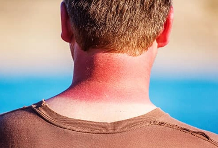Sunburn